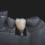 Implantes dentales inmediatos todo lo que debes saber